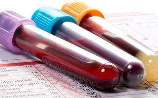Зачем рекомендуют сдавать анализ крови на ревматоидный фактор?