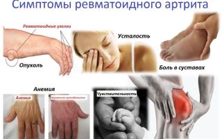 Ревматоидный артрит, основные симптомы болезни