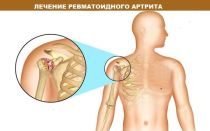Клинические рекомендации при ревматоидном артрите: специфика диагностики, лечения