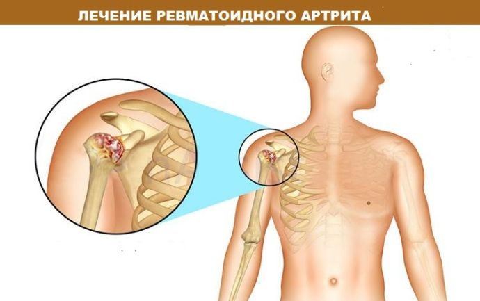 лечение ревматоидного артрита