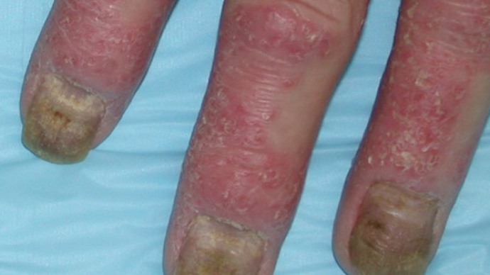 поражение пальцев при псориатическом артрите