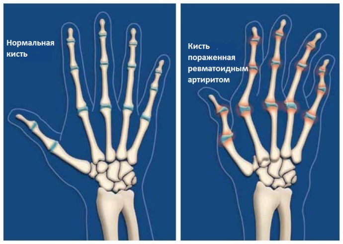 диагностика ревматоидного артрита кистей рук