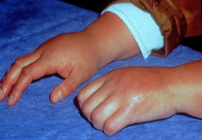 ревматоидный артрит у ребенка